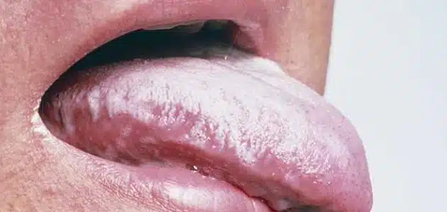 سرطان اللسان