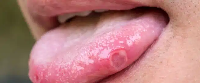 سرطان اللسان