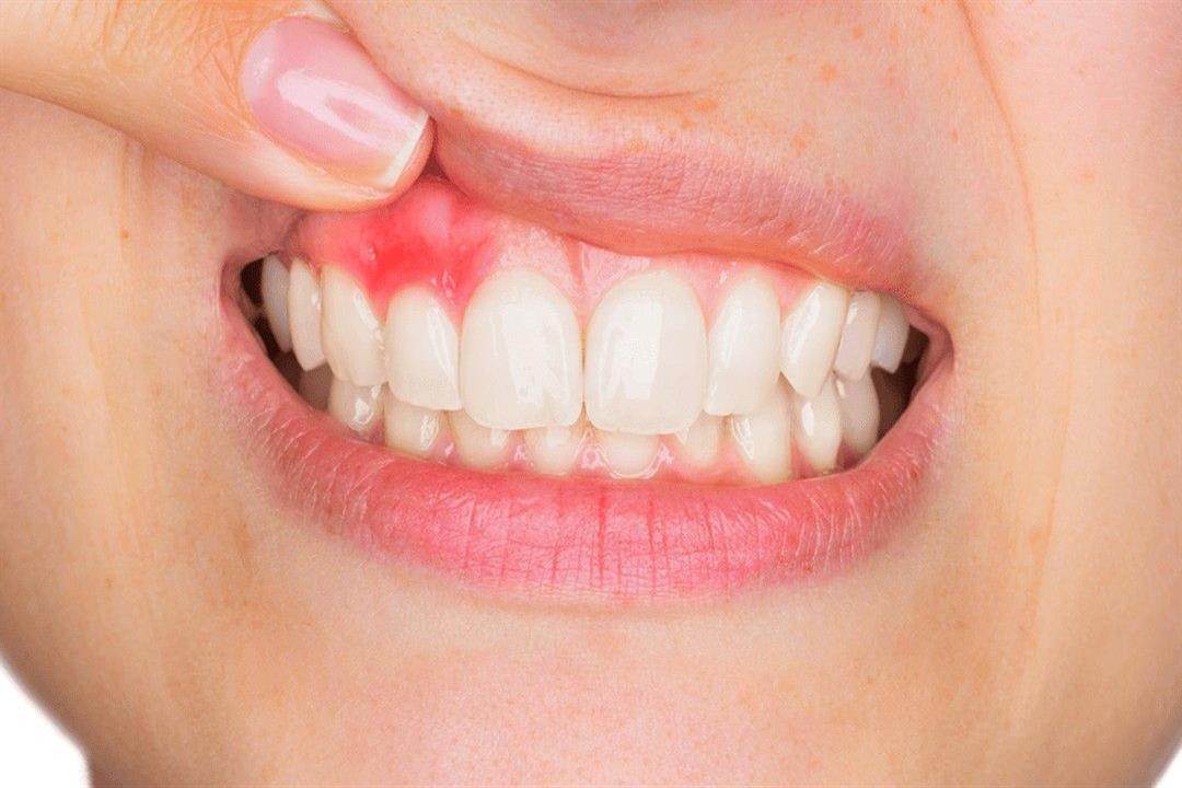 علاج التهاب اللثة
