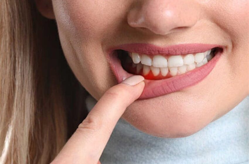 علاج التهاب اللثة