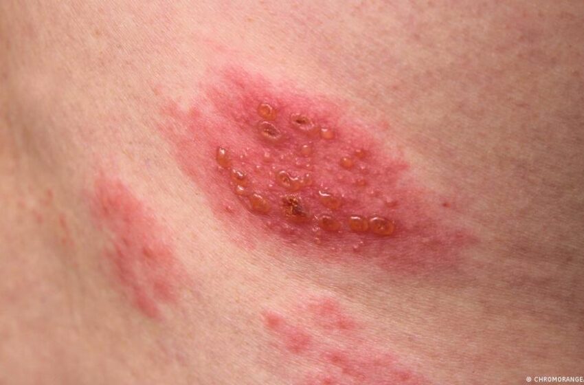 علاج الحزام الناري