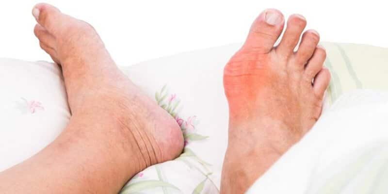 علاج النقرس