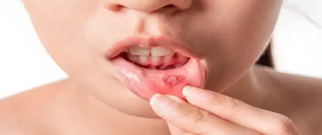 أسباب وأعراض وعلاج تقرحات الفم