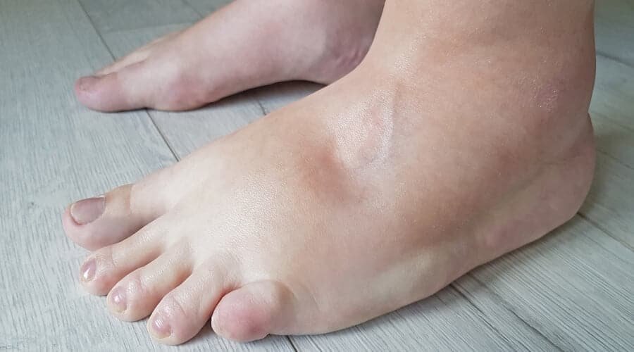 اسباب انتفاخ القدمين وطرق علاجها والوقاية منها