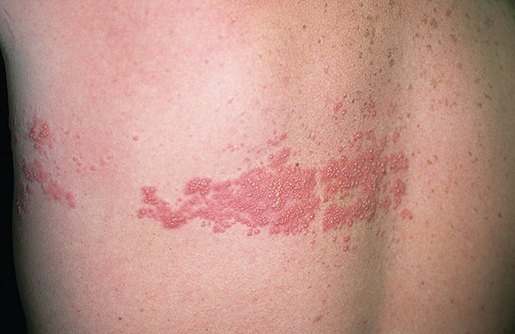 علاج الحزام الناري