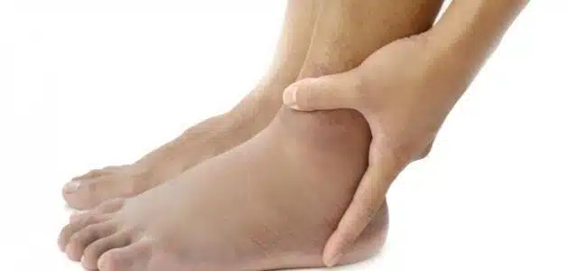 اسباب انتفاخ القدمين وطرق علاجها والوقاية منها