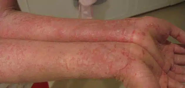 علاج الاكزيما