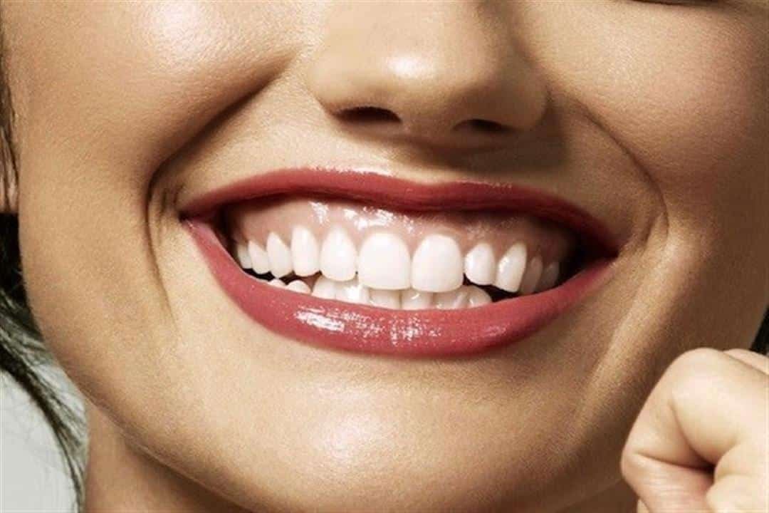 علاج الابتسامة اللثوية