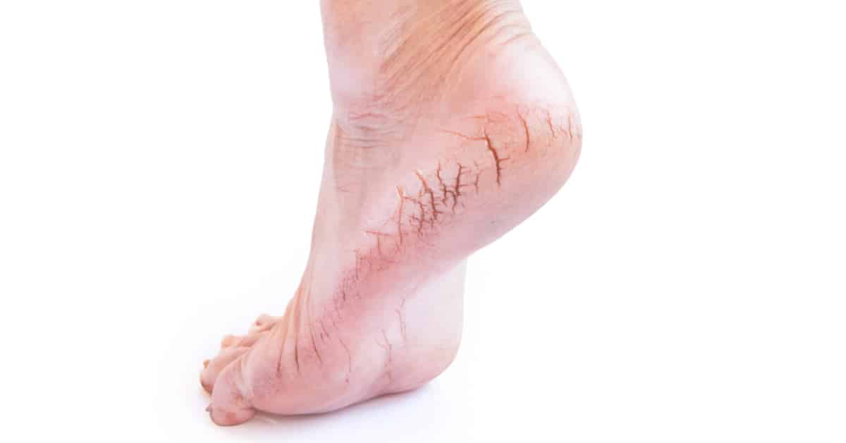 علاج تشقق القدمين