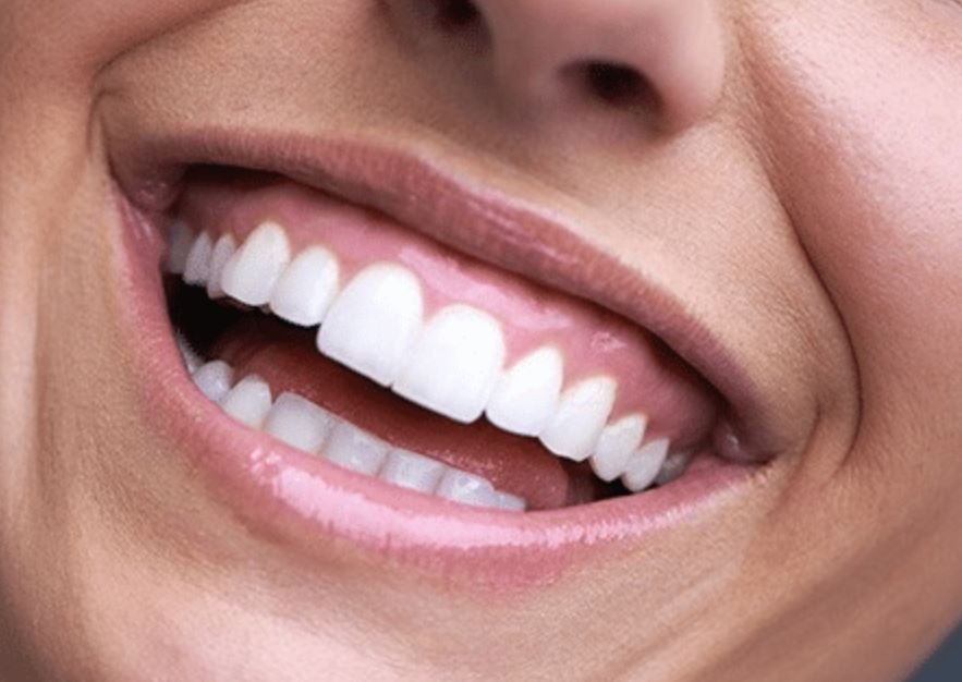 علاج الابتسامة اللثوية