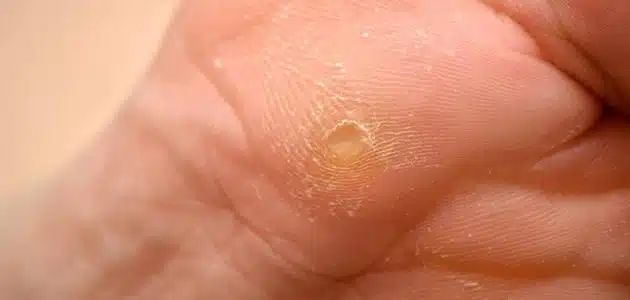 علاج مسمار القدم