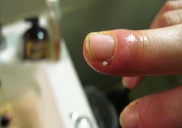 علاج الإصبع المدوحس في المنزل