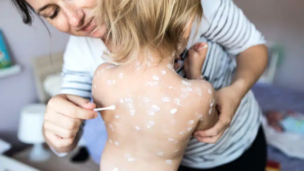 أعراض جدري الماء عند الأطفال